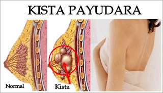 Suplemen Untuk Penderita Kista Payudara Suplemen Untuk Penderita Kista Payudara