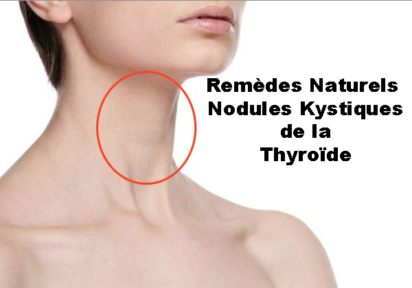 Remèdes Naturels pour les Nodules Kystiques de la Thyroïde