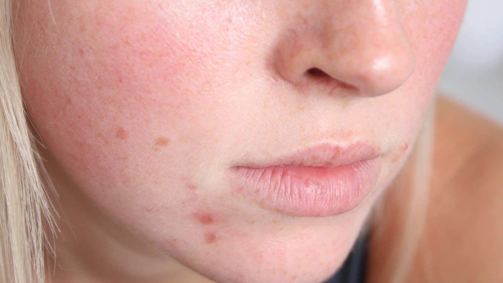 4 Homemade Remedies For Pimples And Skin Care Stay Healthy