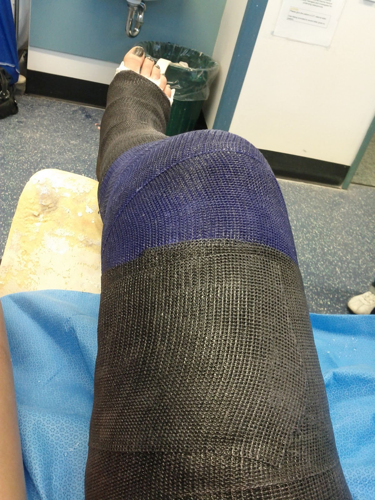 Casts and Toes Real Women Real Broken Legs Episode 20