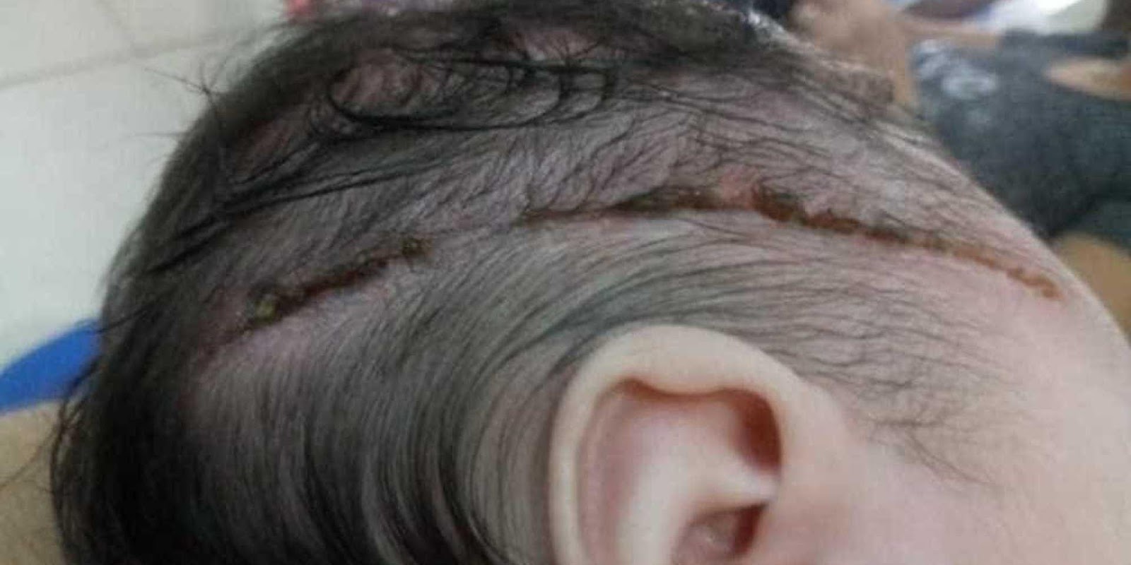 Recém-nascida é cortada na cabeça com bisturi durante parto Recém-nascida é cortada na cabeça com bisturi durante parto