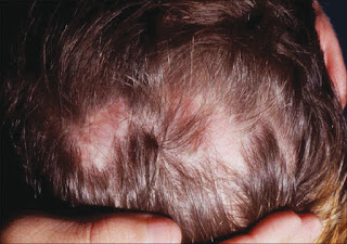 Jenis Kebotakan Alopecia Pressura 