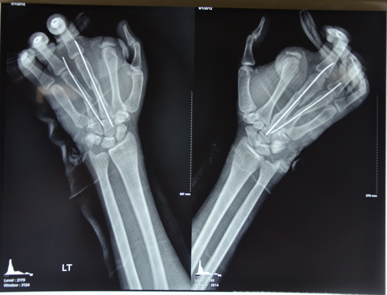 CRUSH INJURIES OF HAND AND UPPER LIMB INJURIES: MAJOR CRUSH INJURY LEFT