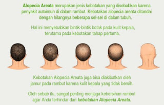 cara mengatasi rambut rontok shampo rambut rontok, obat rambut rontok parah, cara mengatasi rambut rontok berlebihan, cara mengatasi rambut rontok dan kering, cara merawat rambut rontok dan berketombe, vitamin untuk rambut rontok, cara mengatasi rambut rontok pada pria, mengatasi rambut rontok berjilbab