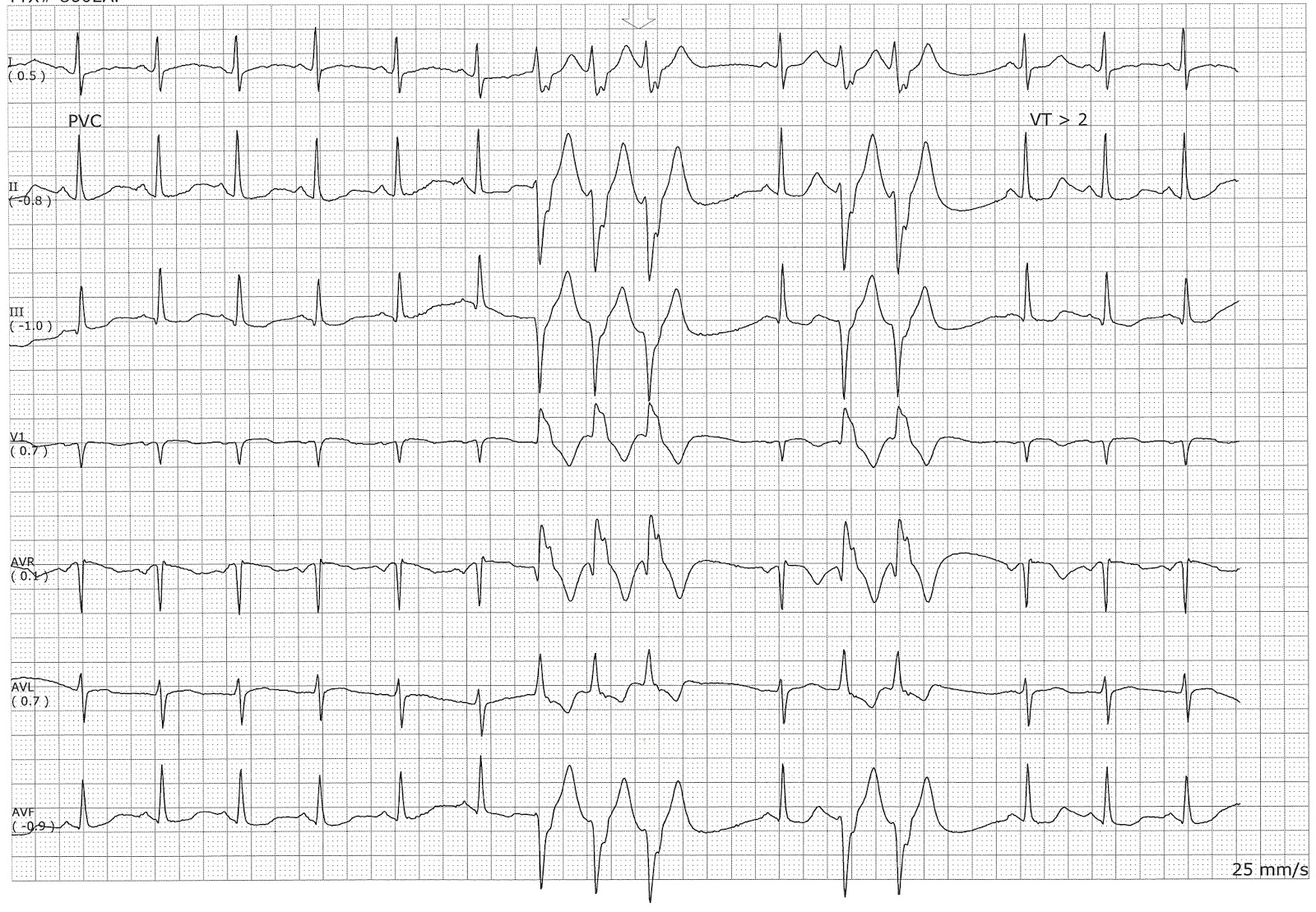Sinus rhythm with a triplet and couplet of PVCs