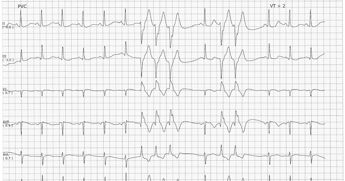 Nurse Health Guides Sinus rhythm with a triplet and couplet of PVCs
