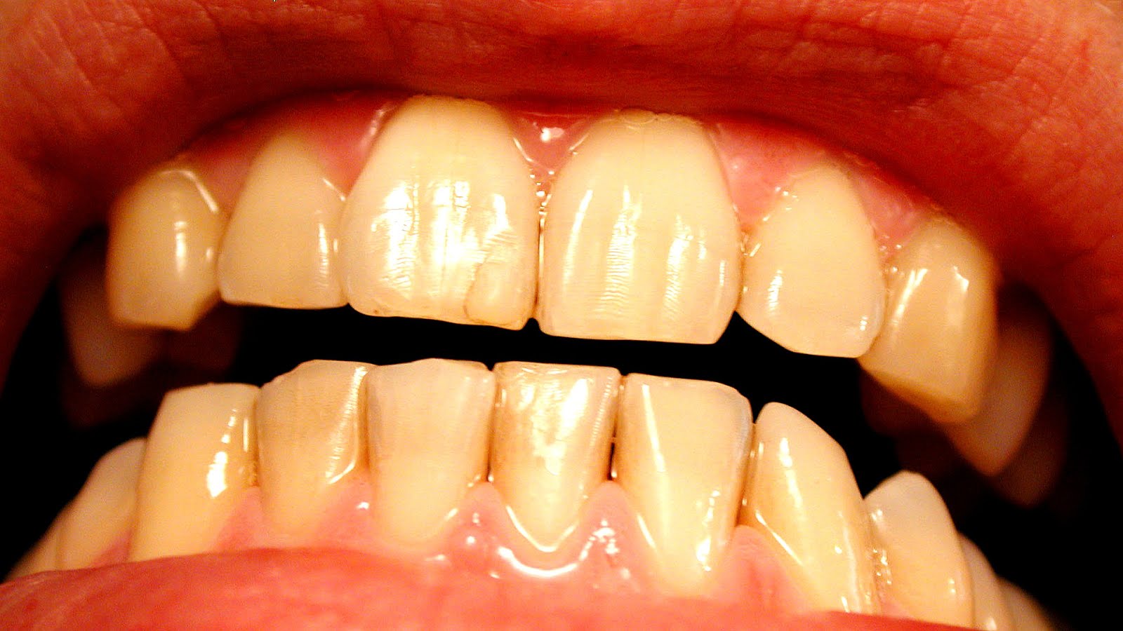 Can You Fix Yellow Teeth Yellow Choices