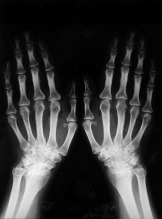 unguente medicamentoase pentru durerile articulare tratamentul a 3 etape ale artrozei genunchiului