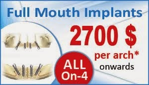 All on 4 Dental Implant Delhi India