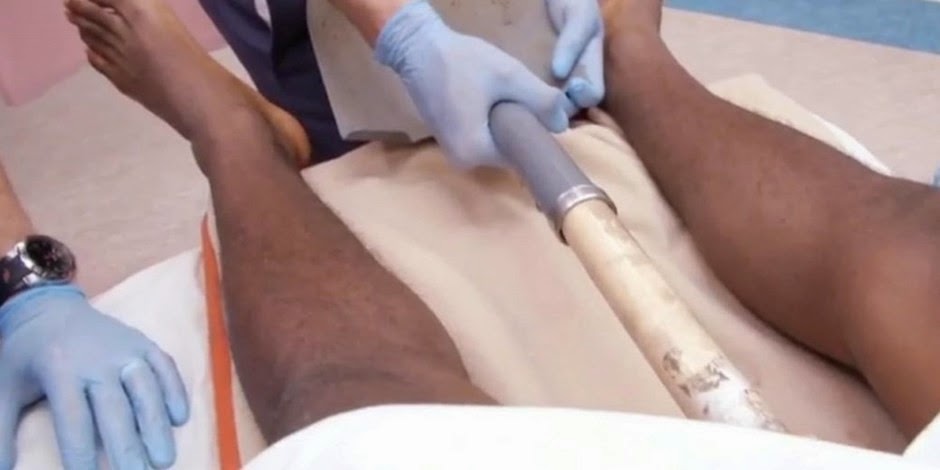 Hospital Accident Catheter Incontinent Cock 35