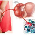 OBAT OLES SIPILIS thumbnail