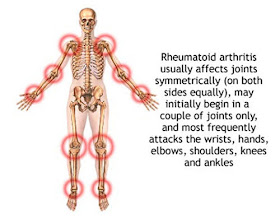 Rheumatoidarthritis usually affect joints symmetrically