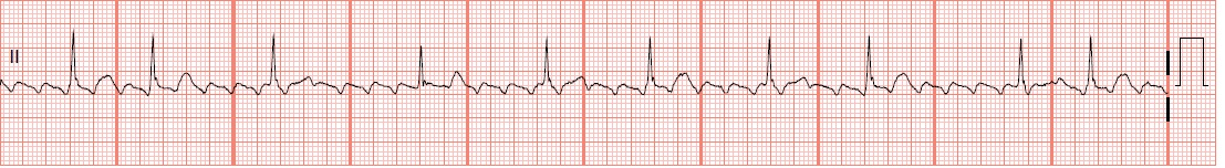 EKG Rhythm Strips 16: Atrial Rhythms