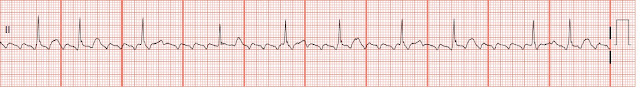 does atrial flutter always turn into afib flutter