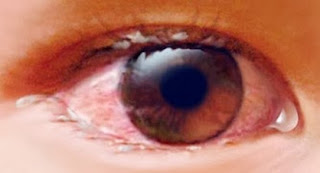 Conjuntivitis Foto de un ojo con conjuntivitis