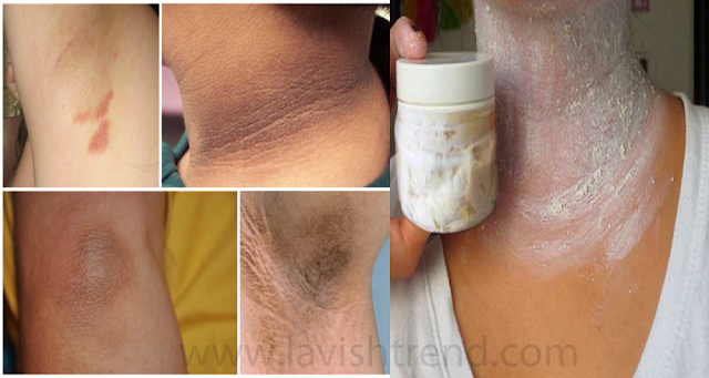 Remove Dirt And Darkness From Your Neck In Just 20 Minutes Remove Dirt And Darkness From Your Neck In Just 20 Minutes