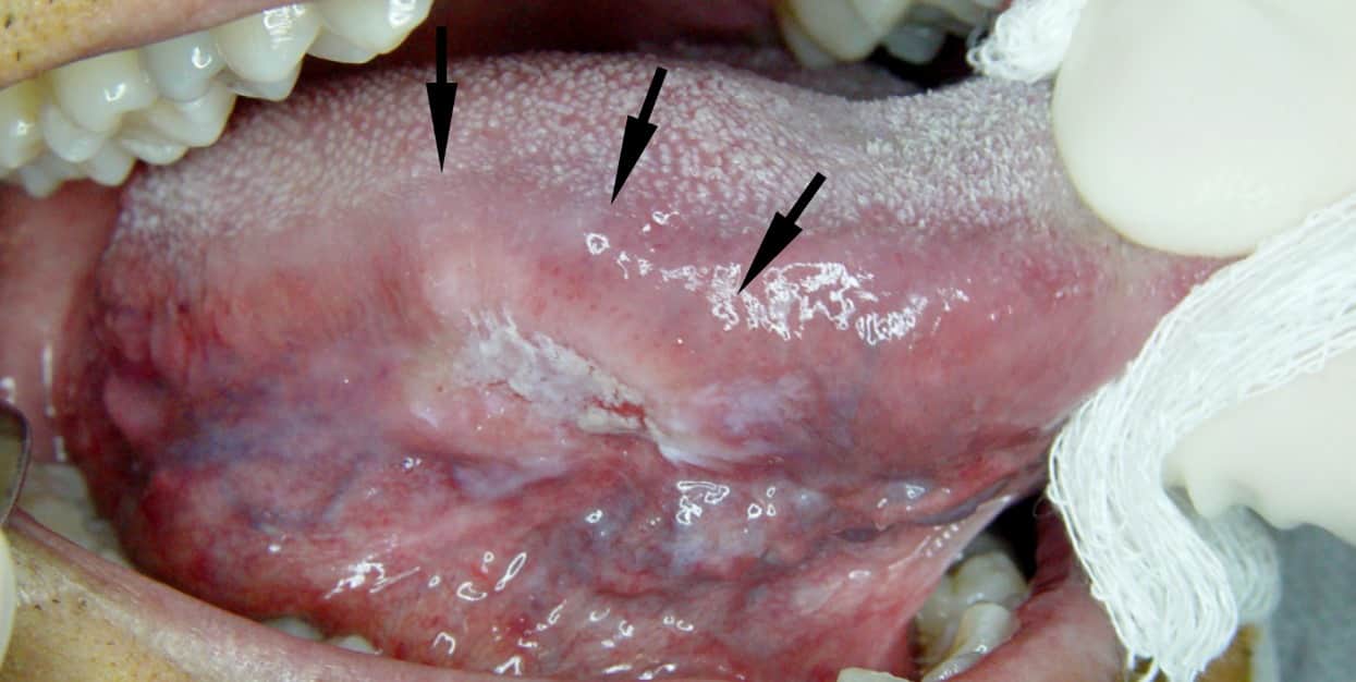 What Is The Life Expectancy Of Throat Cancer CancerWalls