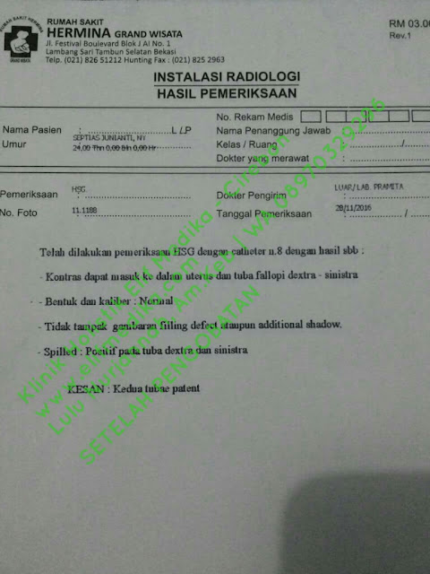 Pengobatan ; 3x datang ke klinik setelah mens, minum herbal 3 paket (3 bulan), Setelah paket ke 3 melakukan periksaan HSG ulang dg hasil paten tuba billateral. Pengobatan ; 3x datang ke klinik setelah mens, minum herbal 3 paket (3 bulan), Setelah paket ke 3 melakukan periksaan HSG ulang dg hasil paten tuba billateral.