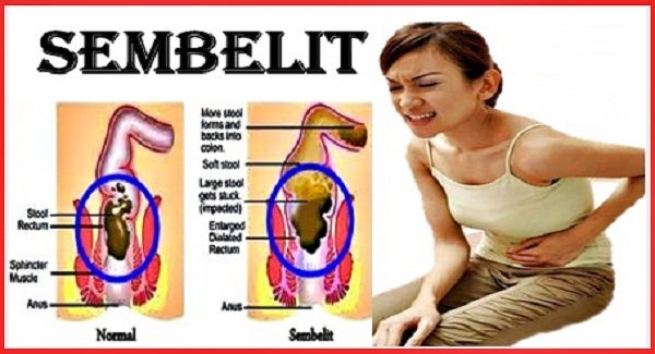 Bahaya Sembelit Bahaya Sembelit