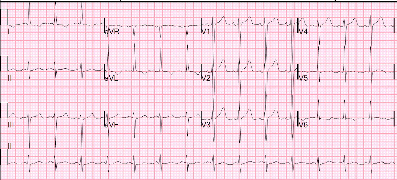 Dr. Smith's ECG Blog: Is there ST Segment Depression here?
