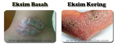 Foto obat eksim tradisional ampuh dan aman