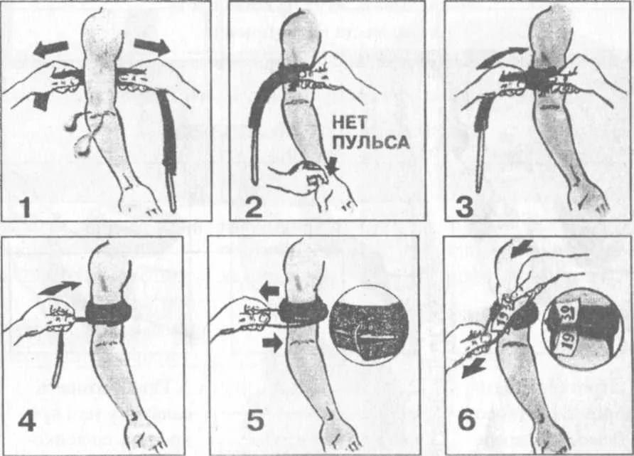 техника наложения кровоостанавливающего жгута алгоритм. наложение артериального жгута на плечо. наложение резинового артериального жгута. наложение артериального жгута на плечо. наложение кровоостанавливающего жгута алгоритм.
