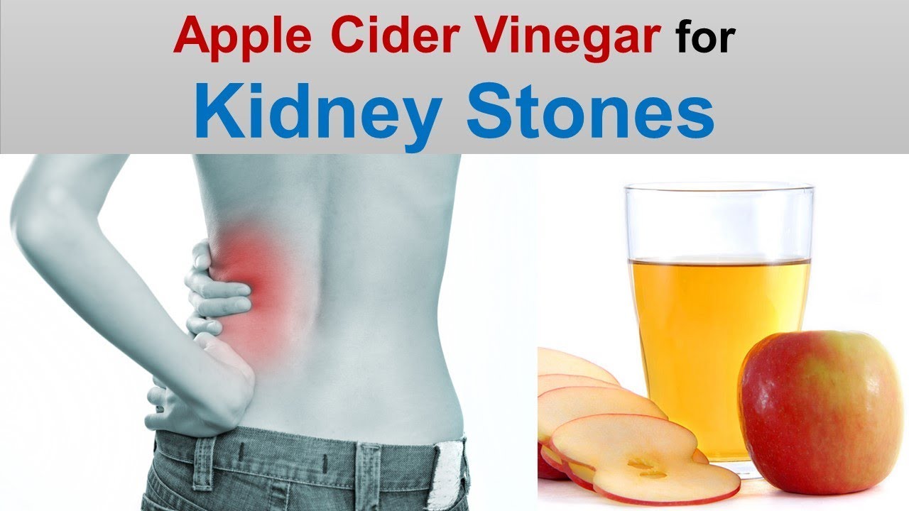 Mix A Lemon, Olive Oil And Vinegar To Dissolve Kidney Stones