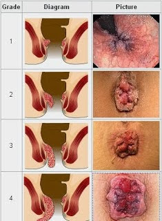 Benjolan Disekitar Anus