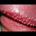 Obat Kutil Kelamin Bali thumbnail