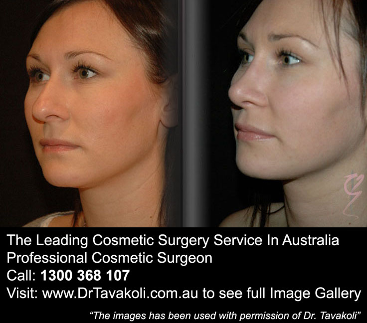Is Non Surgical Nose Job Worth It The Leading Cosmetic Surgery Service In Australia
