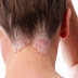 Psoriasis is a skin disease that causes scaling and inflammation thumbnail