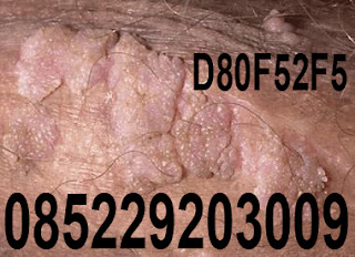 obat kutil Obat Kutil - untuk menyembuhkan kutil di kulit kemaluan kelamin yang aman & ampuh terbuktinya dapat menghilangkan kutil kelamin, obat kutil buat pada untuk pria laki-laki wanita perempuan Ibu hamil mengandung menyusui, obat kutil dikemaluan kelamin genital