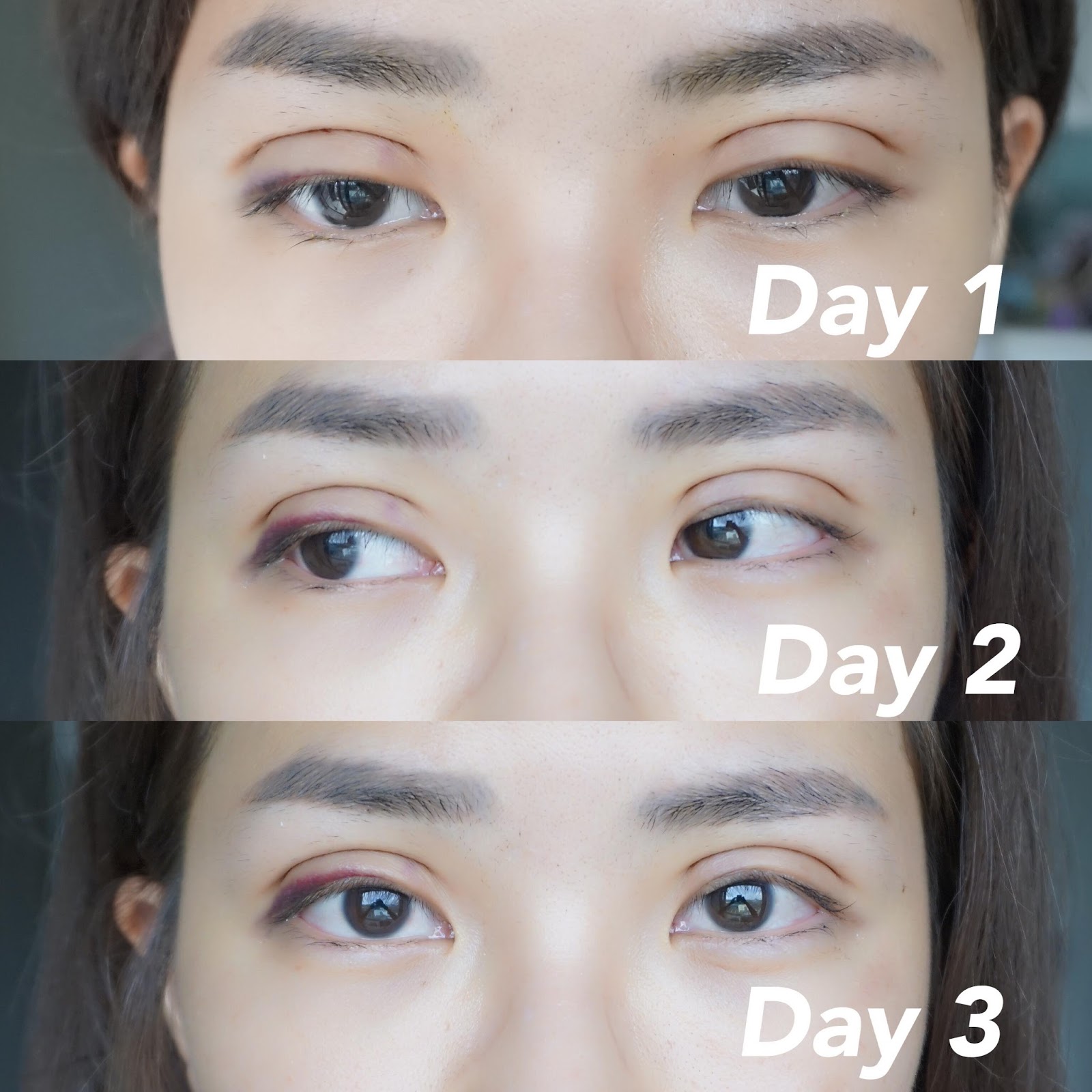 Karen Kho Why do i redo my Double Eyelids