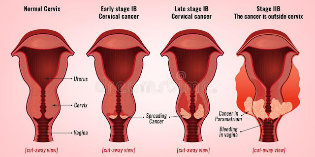 ung thư cổ tử cung phát triển