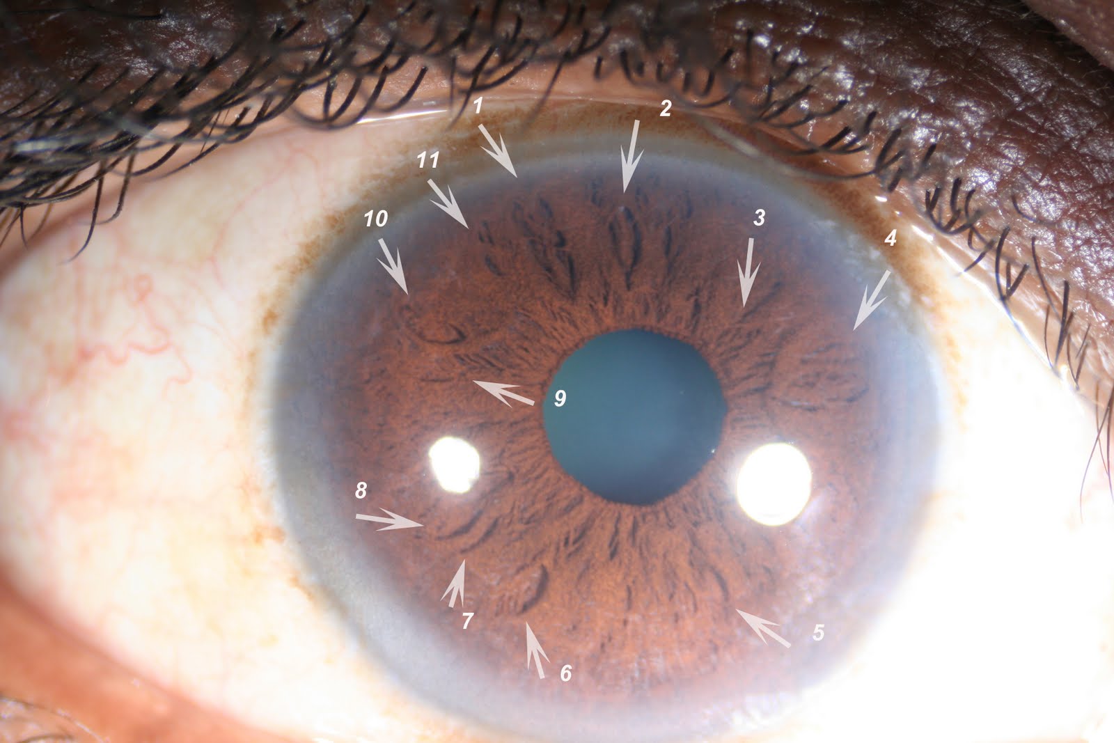 Modern & Multidimensional Iridology Analysis of Lacuna & Crypt
