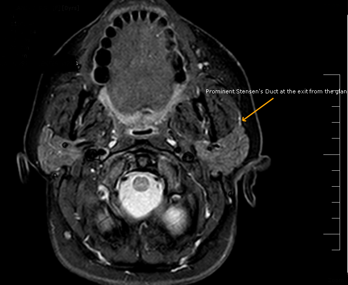 Stensen's DuctMRI Sumer's Radiology Blog