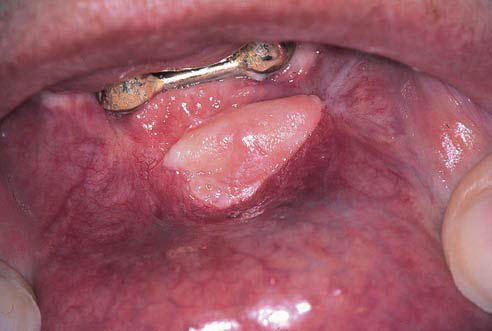 Skin Tag Inside Mouth 35
