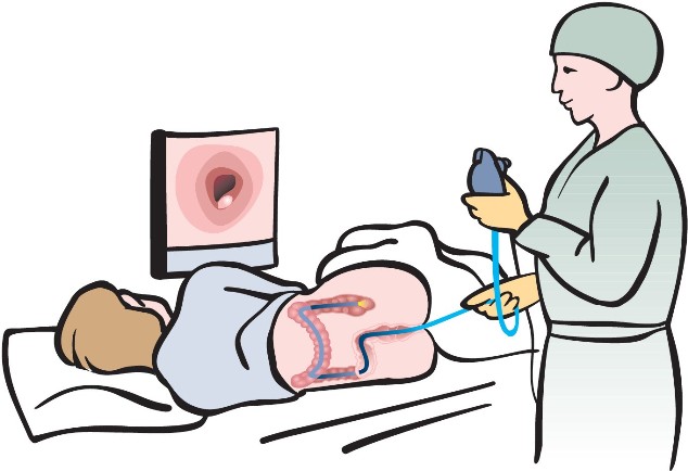CPT Codes for Colonoscopy with Biopsy, Polypectomy, APC