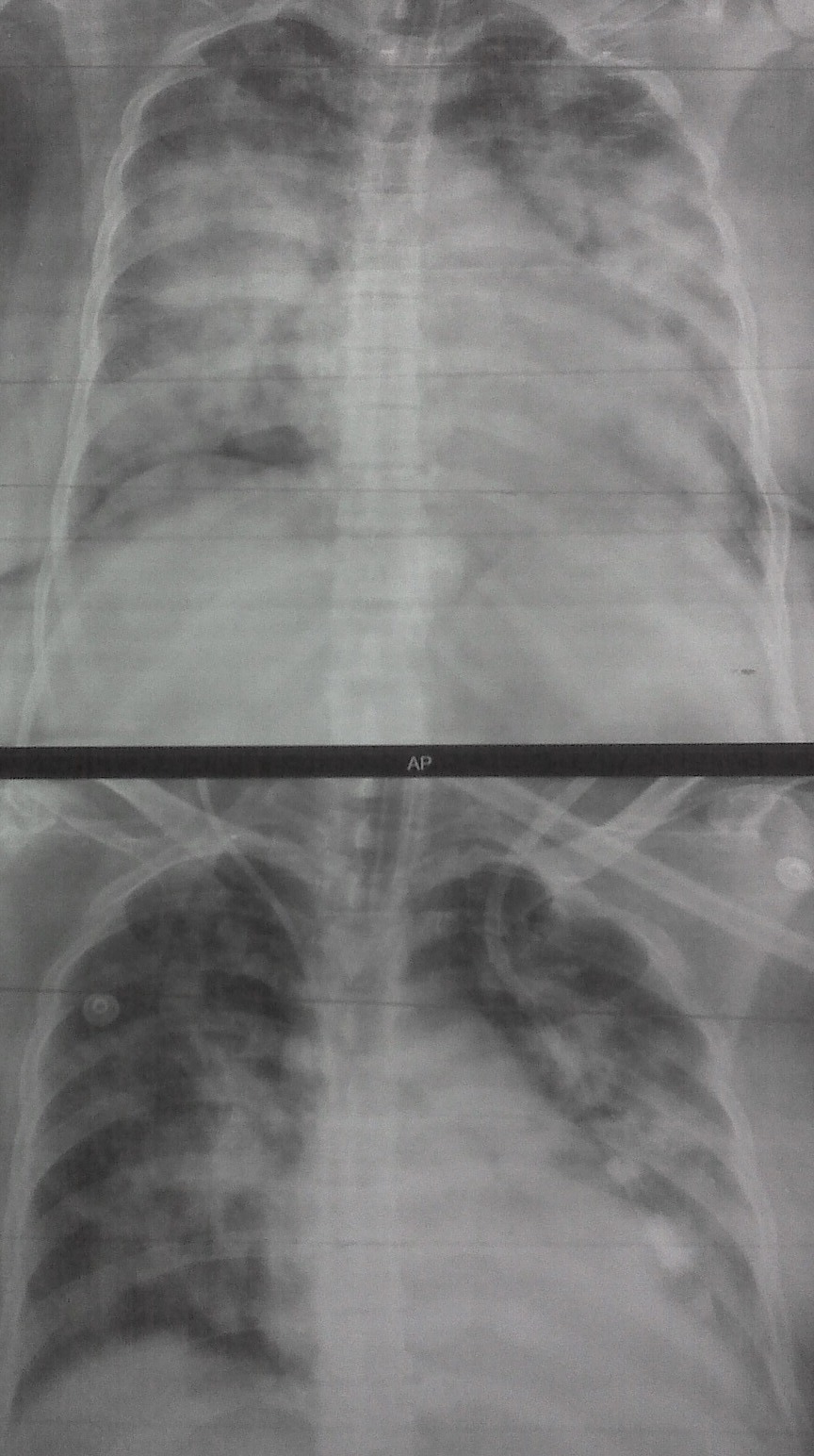 Pulmonary Edema CXR Sumer's Radiology Blog