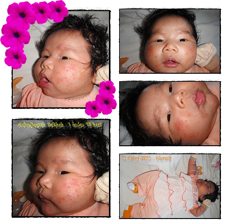 Ubat Kurap Di Muka  Satu Huruf r