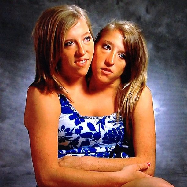 Conjoined Twins Brittany And Abby Hensel Are Married?