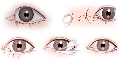 Phẫu thuật mở rộng góc mắt trong như thế nào (2)