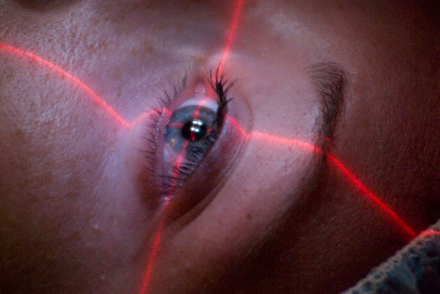 Lasik Eye Surgery