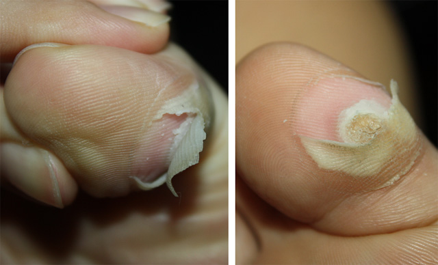 baby foot plantar wart