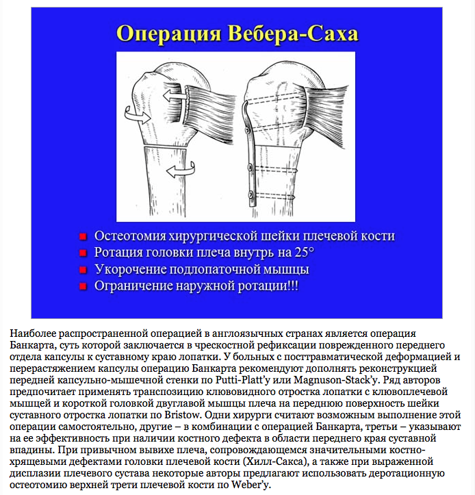 Операция привычного вывиха. Комбинированные операции. Операции при привычном вывихе плечевой кости. Плечелопаточный сустав,вывих. Внутрисуставной вывих плеча.