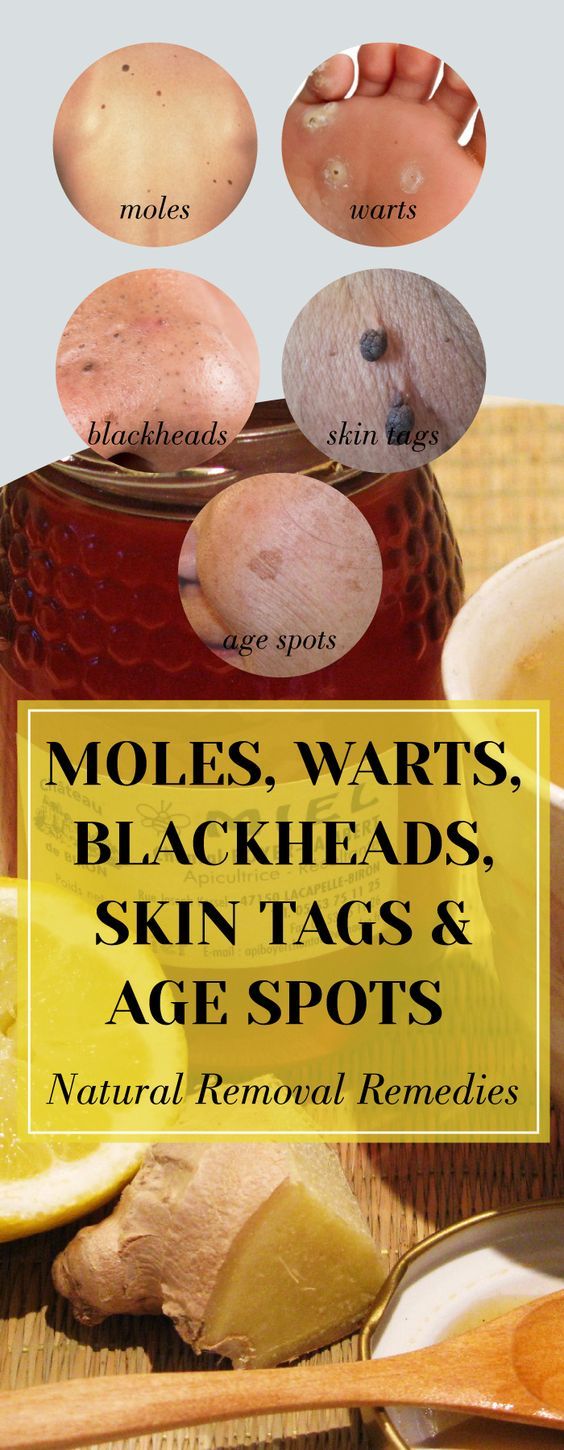 Moles Warts Blackheads Skin Tags And Age Spots Natural Removal
