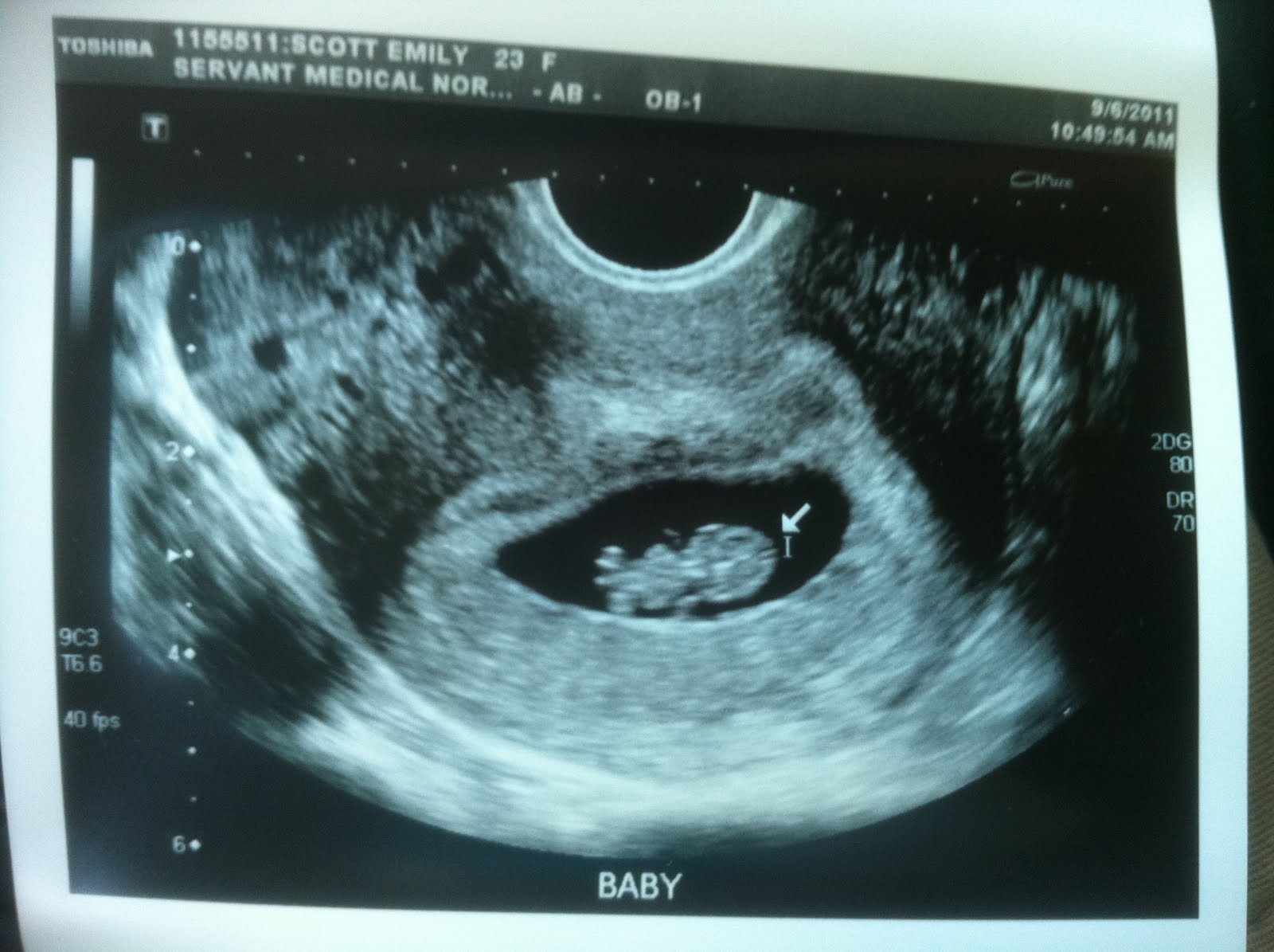 The Scott Family: Ultrasound - 9 weeks