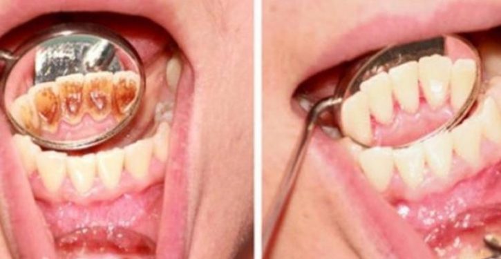 A Powerful Tip To Remove Tartar From Your Mouth Easily