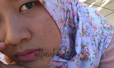 menghilangkan-bekas-jerawat