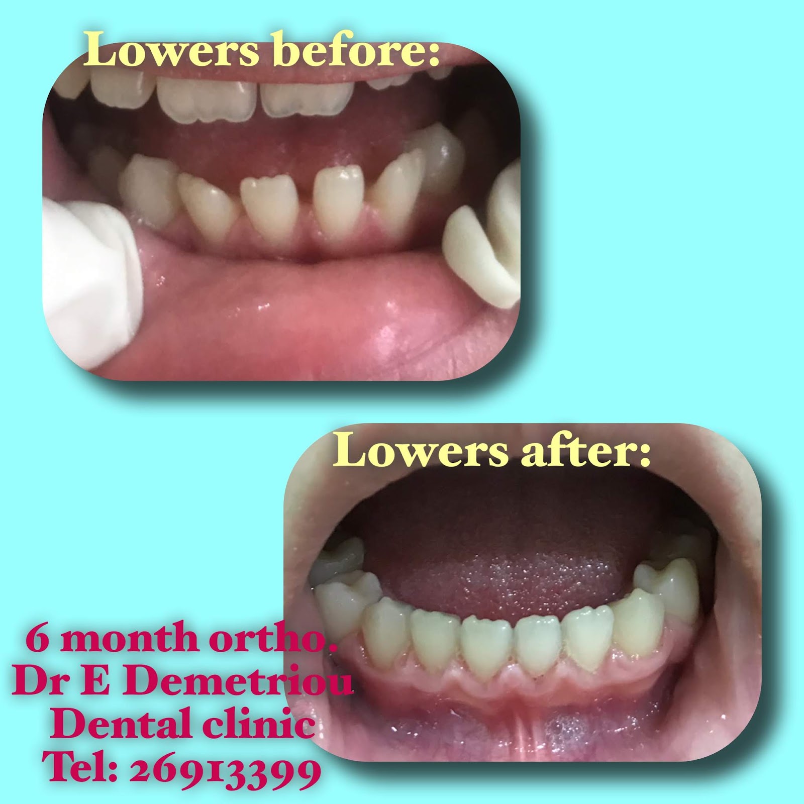 Paphos Dentist, Dr Elena Demetriou Examples of our work